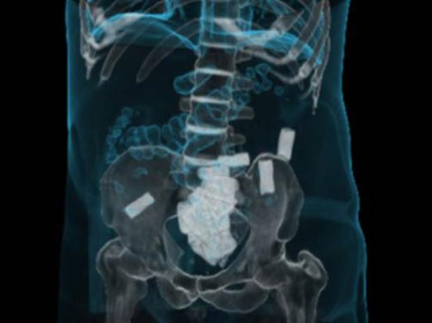 Placa. Una imagen de tomografía ilustra donde llevan la droga las 'mulas'.