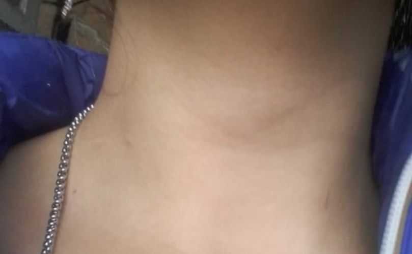 La vecina exhibió la marca que le dejo en el cuello